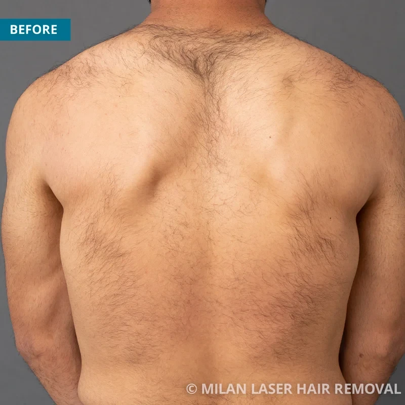 Men's Before & After Photos of Laser Hair Removal | Milan Laser in San  Antonio, TX