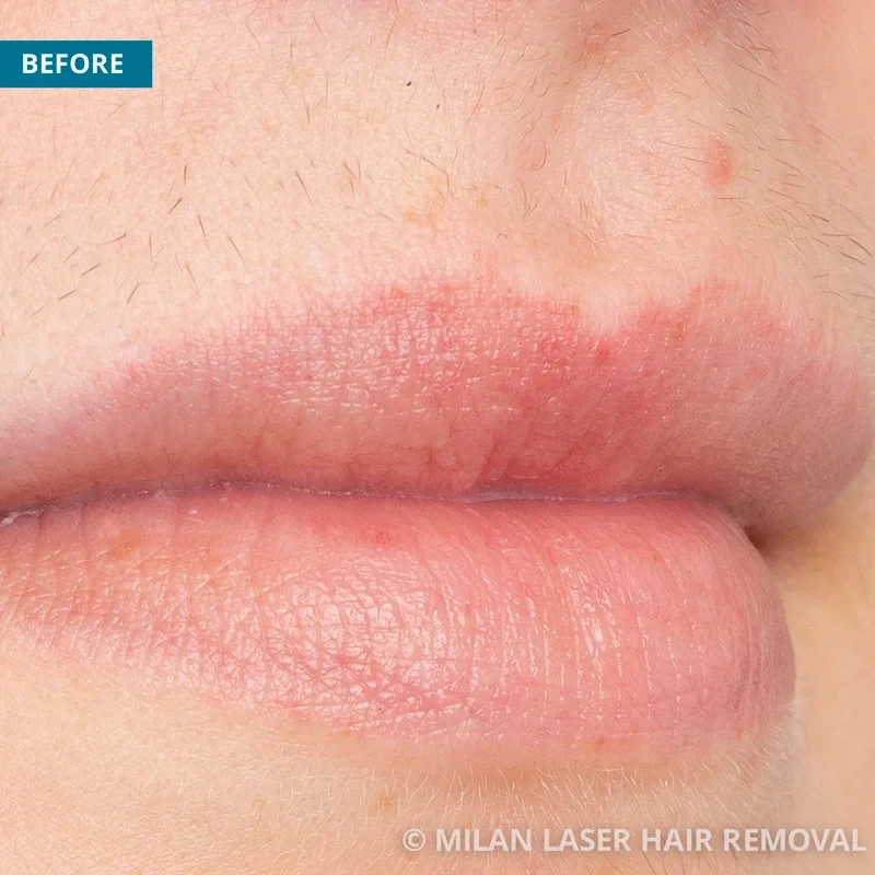 Face Before & After Photos of Laser Hair Removal | Milan Laser in San  Antonio, TX